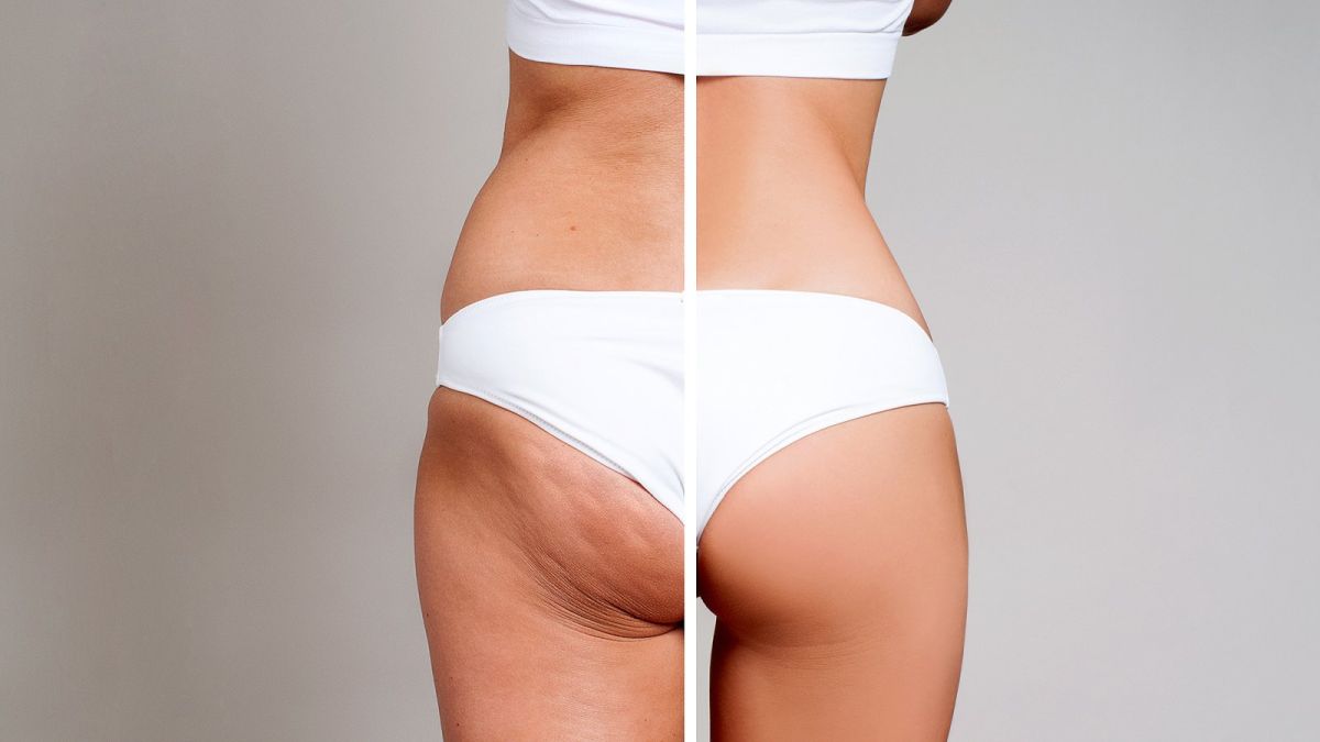 get rid of a cellulite